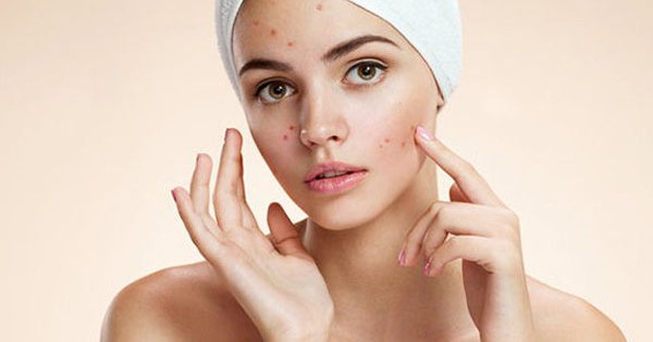 Cinque cose che non sai dell'acne