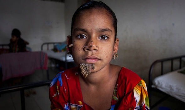 La prima bambina al mondo con la sindrome dell'uomo albero albero