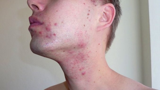 Perché l'acne è legata agli ormoni Perché l'acne è legata agli ormoni
