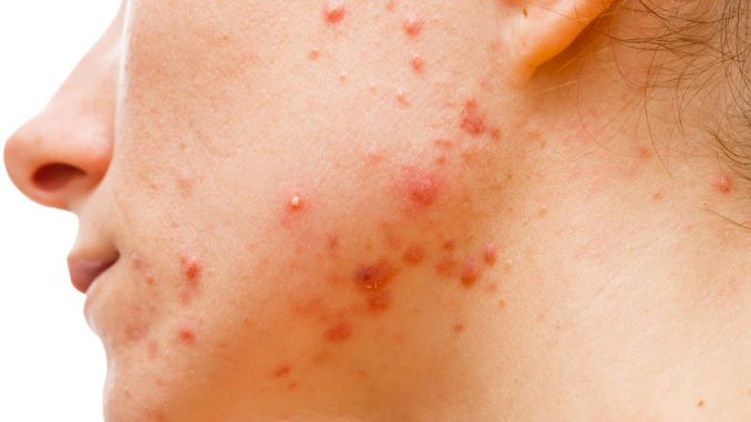 Acne: come riconoscerla Acne: come riconoscerla
