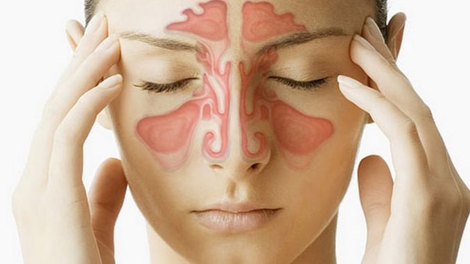 Quale antibiotico usare per curare la sinusite