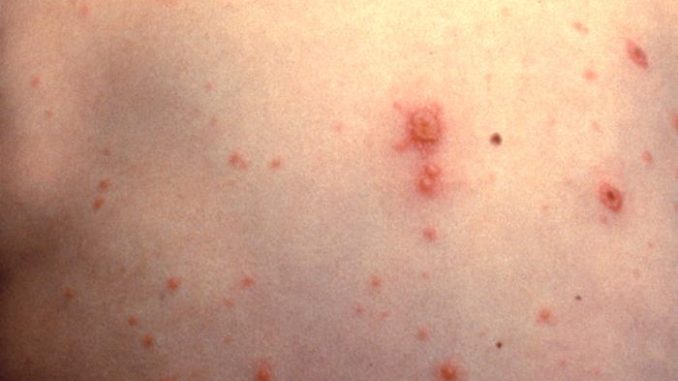 varicella-rimedi-al-prurito varicella