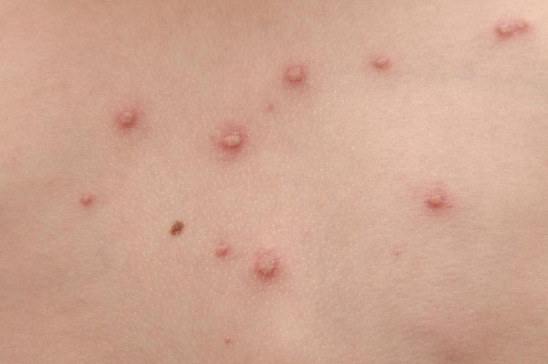 Varicella: come prevenire il contagio a scuola Varicella: come prevenire il contagio a scuola