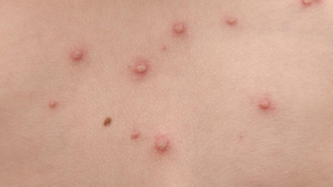 Varicella: come si trasmette Varicella: come si trasmette