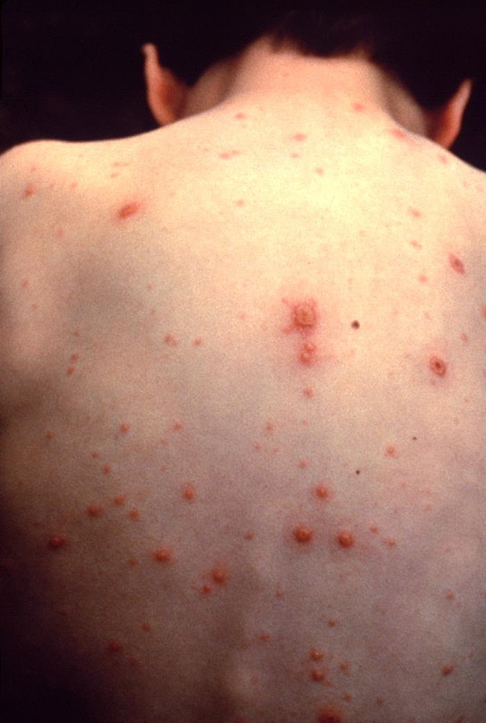 varicella-rimedi-al-prurito varicella