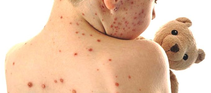 Il morbillo è una malattia infettiva di origine virale che si manifesta sottoforma di febbre molto elevata, congiuntivite e bronchite.