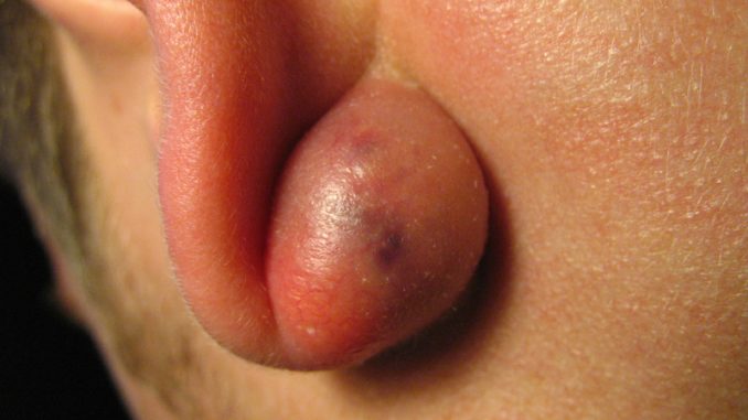 Cisti, i metodi naturali per eliminarle per sempre naturali