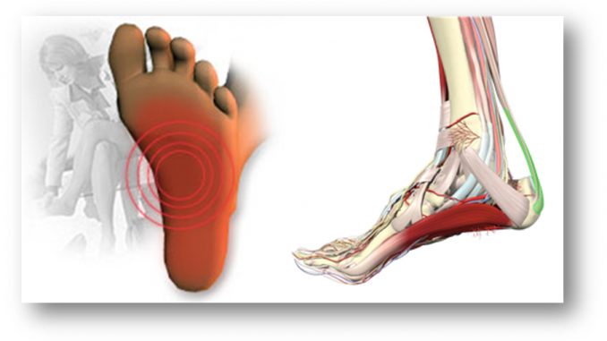 Come curare dolori cronici con la fascia plantare fascia
