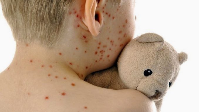 Vaccini, commissario Ue: "deplorevole epidemia morbillo in Italia" morbillo