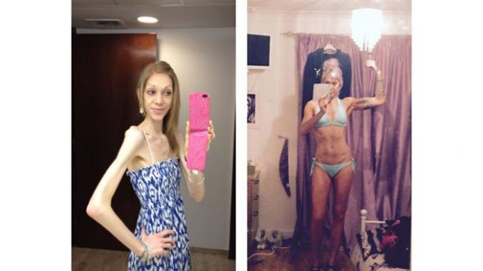 Nicola King Anoressia