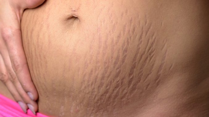 smagliature smagliature