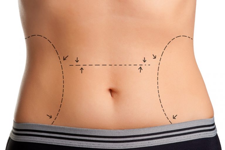 Cellulite: come ridurre l'assorbimento dei grassi Cellulite