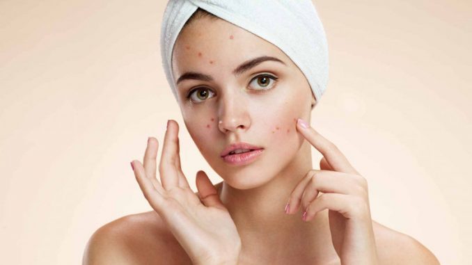 ACNE SUL VISO. ACNE SUL VISO.