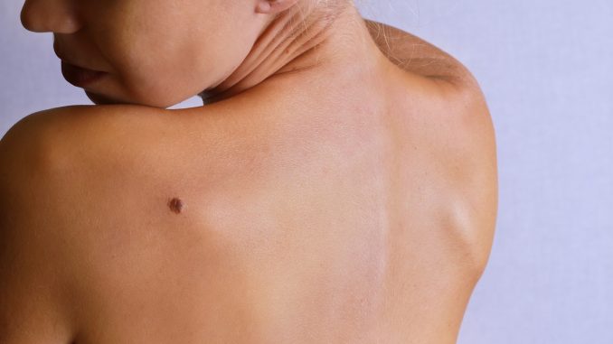 Nei: che cosa significano in base alla loro posizione sul corpo nei