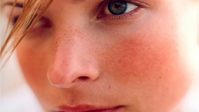 Acne rosacea: cause, rimedi, prodotti da utilizzare Acne rosacea: cause, rimedi, prodotti da utilizzare