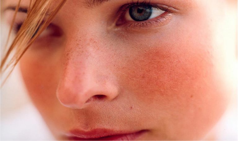 Acne rosacea: cause, rimedi, prodotti da utilizzare Acne rosacea: cause, rimedi, prodotti da utilizzare