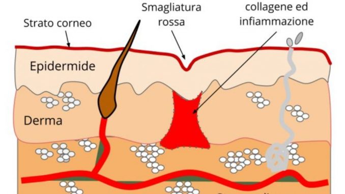 smagliature rosse Smagliature