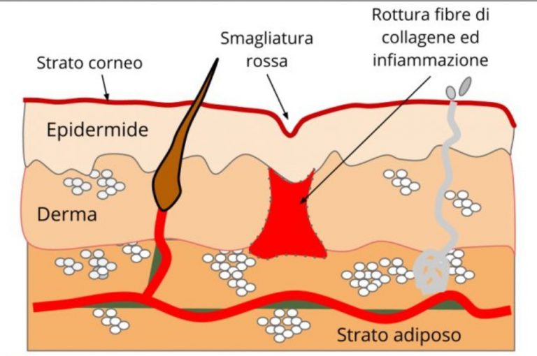 smagliature rosse Smagliature