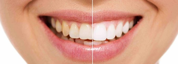 Denti-gialli.....