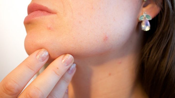 acne-1606765_960_720