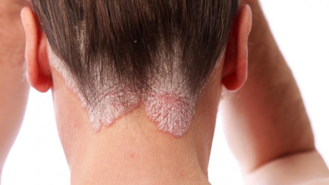 Psoriasi: come trattare la malattia cronica della pelle psoriasi
