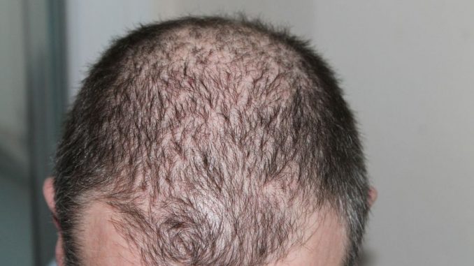 Come evitare perdita dei capelli in modo naturale perdita capelli