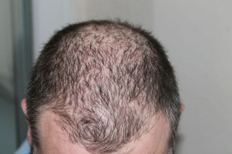 Come evitare perdita dei capelli in modo naturale perdita capelli