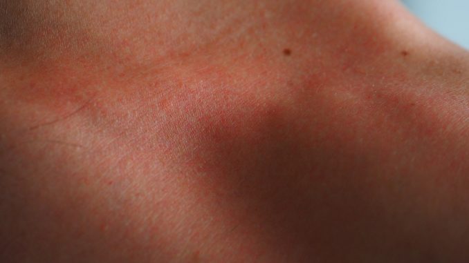 sunburn-2117351_960_720