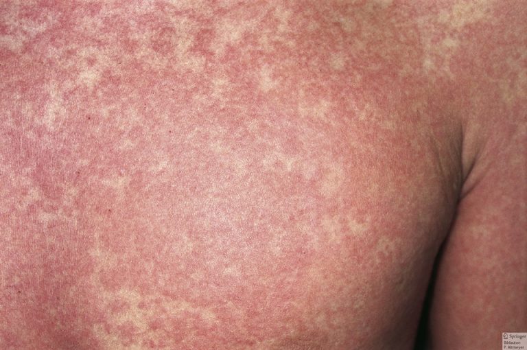 Non era stato vaccinato: quarantaduenne muore di morbillo a Catania Non era stato vaccinato: quarantaduenne muore di morbillo a Catania