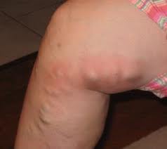 Se è possibile interessarsi didoneità a thrombophlebitis delle estremità più basse
