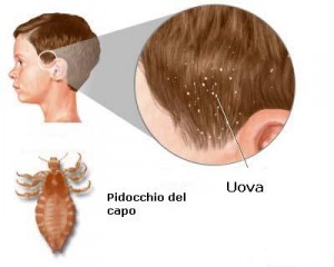 Pidocchi uova 300x240