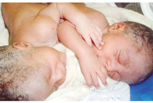 The conjoined twins in an incubator at Kabale regional referral. PHOTO BY ROBERT MUHEREZA