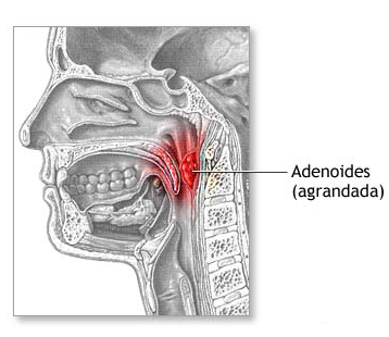adenoide2