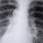 thorax asthma 800x800 150x150