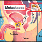 Metastatic Prostate Cancer 1 150x150
