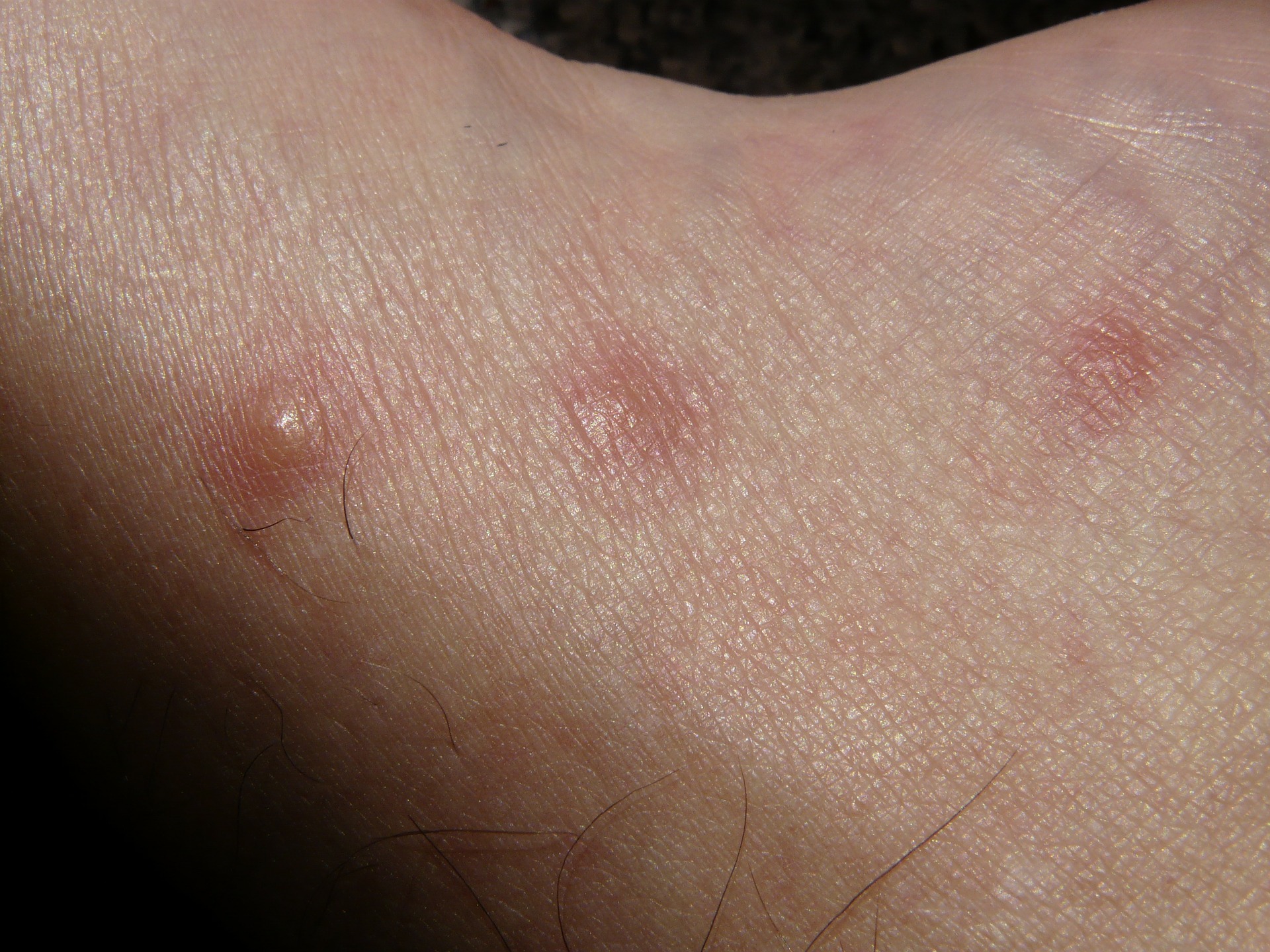 orticaria pruriginosa su mani e piedi