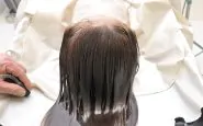 Prurito del cuoio capelluto