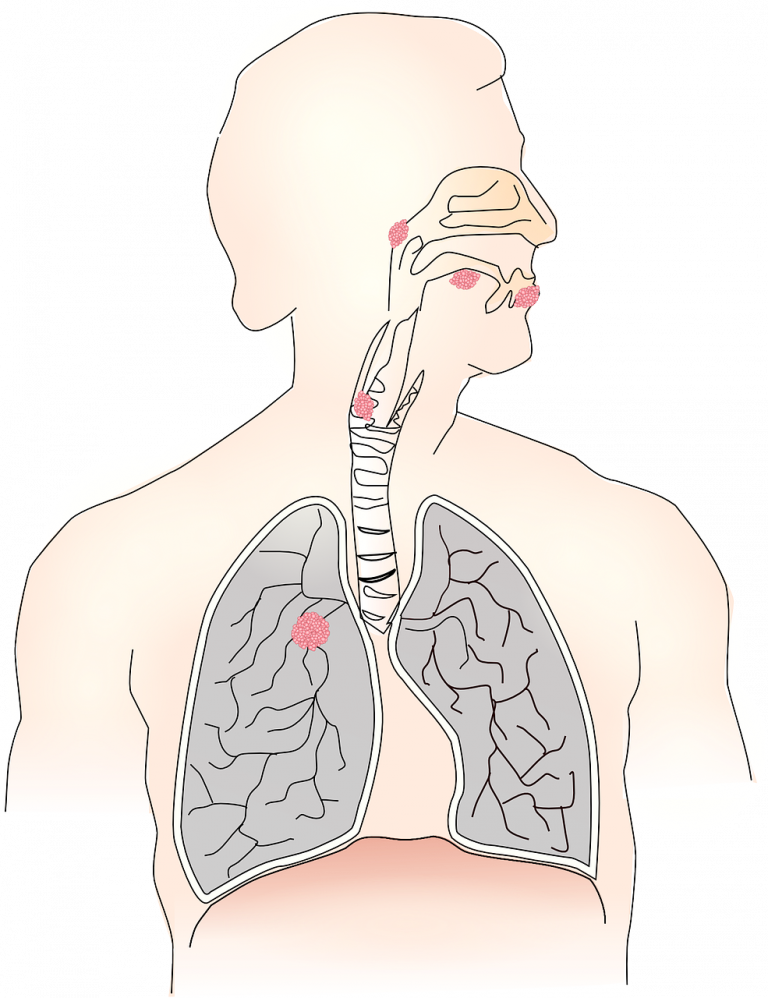cancro alla lingua cancro alla lingua