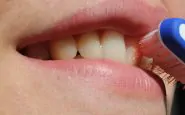 Rimozione del tartaro dai denti