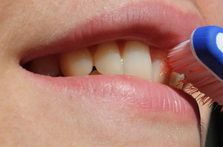 Rimozione del tartaro dai denti