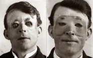 Walter Yeo uno dei primi a sottoporsi chirurgia plastica ed a trapianto di pelle 1917