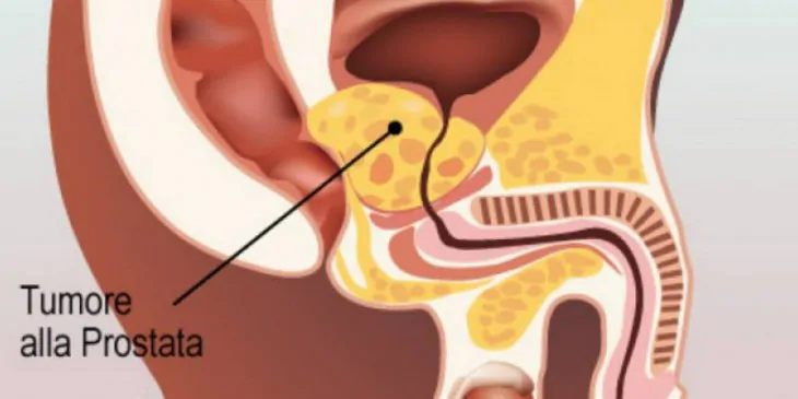 oncologia-tumore-prostata-ranghos-730x365