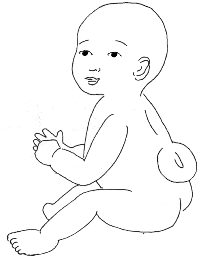 Spina bifida drawing