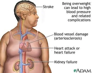 article new ehow images a04 op g6 heart disease caused obesity 800x800