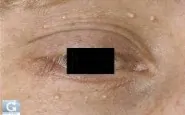 Pallina bianca sull'occhio: la dottoressa la rimuove tagliandola