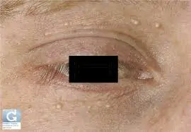 Pallina bianca sull'occhio: la dottoressa la rimuove tagliandola