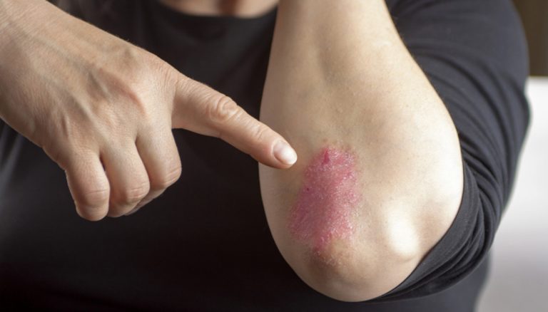 Psoriasi Guttata 768x438