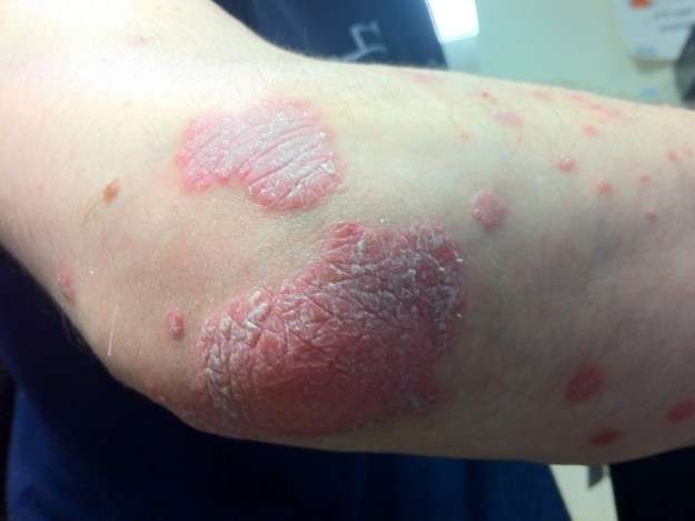 La bioterapia: un nuovo rimedio per curare la psoriasi