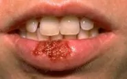 Periodo guarigione di herpes labiale