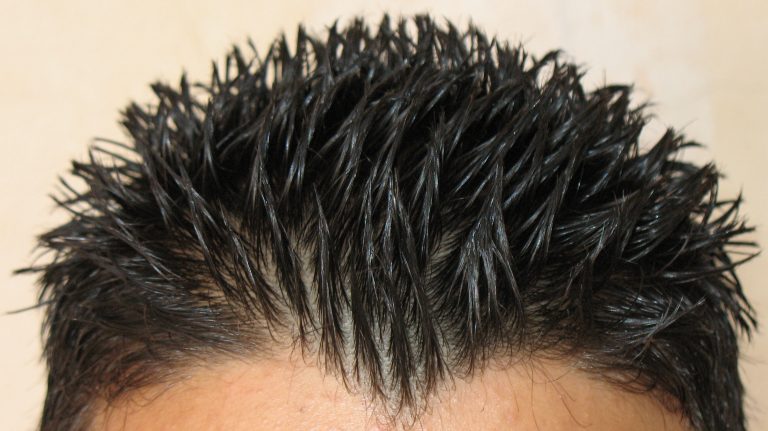 alopecia